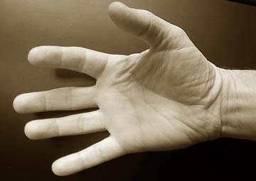Гигрома пальцев рук — СПБ ГБУЗ «Кожно-венерологический диспансер № 4»